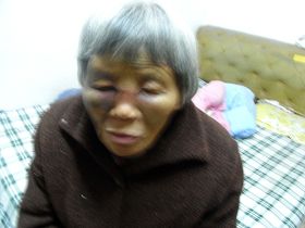 王柳珍的鼻梁被监控她的恶徒打断,双眼被打得青肿,睁不开。