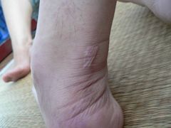 黄成左脚脖子大筋裸露(近照)