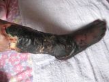 宋会兰被打毒针迫害后,腿脚变黑、小腿腐烂(慎入)。