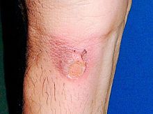 图2:西贡市一位法轮功学员手上因警察铐手铐和火烧而留下的伤