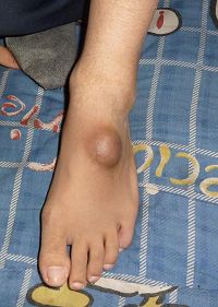 '二零一一年四月拍的照片:脚上如核桃大小的硬鼓包。'