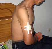 被迫害后的陈继海,胳膊上还打着钢板