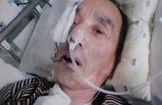 '李德成被迫害致左脸萎缩,左眼塌陷失明'