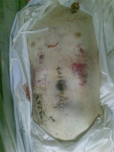图:徐浪舟遗体血瘀斑驳(摄于死后第三天,疑遭重殴)