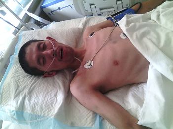 张国立在庄河中心医院重症监护室(ICU),胳膊和胸口处可以看出在看守所被殴打后的青紫