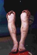 被成翠贞(女)踢过的双腿,大约拍于2004年秋天被踢一年之后