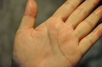 图:当年左手掌被划破的伤痕仍然依稀可见。