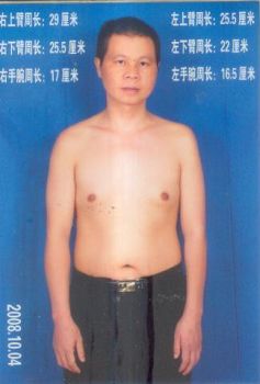 岳阳孙平华被酷刑折磨后,左手臂肌肉萎缩