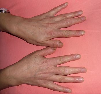 李亚娟被关押在黑龙江省女子监狱小号双手冻成大骨节,至今没好(此照片拍于二零一五年一月)