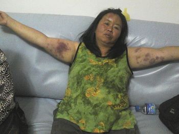 唐玉被毒打,头部、两臂和大腿均受伤