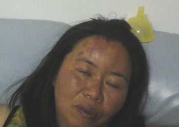 唐玉被毒打,头部、两臂和大腿均受伤