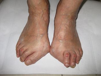 徐莲香目前照片:从照片中可以看到我手骨、脚骨严重变形。但我现在腰杆挺直,可以双盘腿打坐两个小时,这在正常人都是很难做到的。