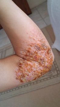和炼功后(二零一六年二月二十七日)对比