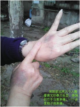 图1:宾阳派出所八个人围着唐文珍暴力采血,使她的双手乌青肿痛