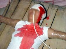 '酷刑:固定灌食'