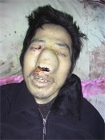 '常永福去世时鼻子肿大,鼻内、口中有血块,双耳、眼角流血'