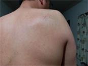 '腰背部、右肩胛部软组织挫伤,右侧胸部、臀部、右手背外侧软组织挫伤'