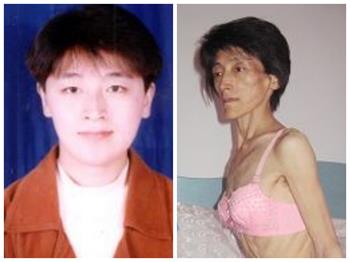 左图:宋艳群被迫害前的照片;右图:遭迫害后宋艳群刚出院的照片。