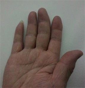 图3:王晓玲右手手指变形。
