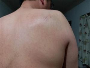 '邱安遭殴打,腰背部、右肩胛部软组织挫伤'
