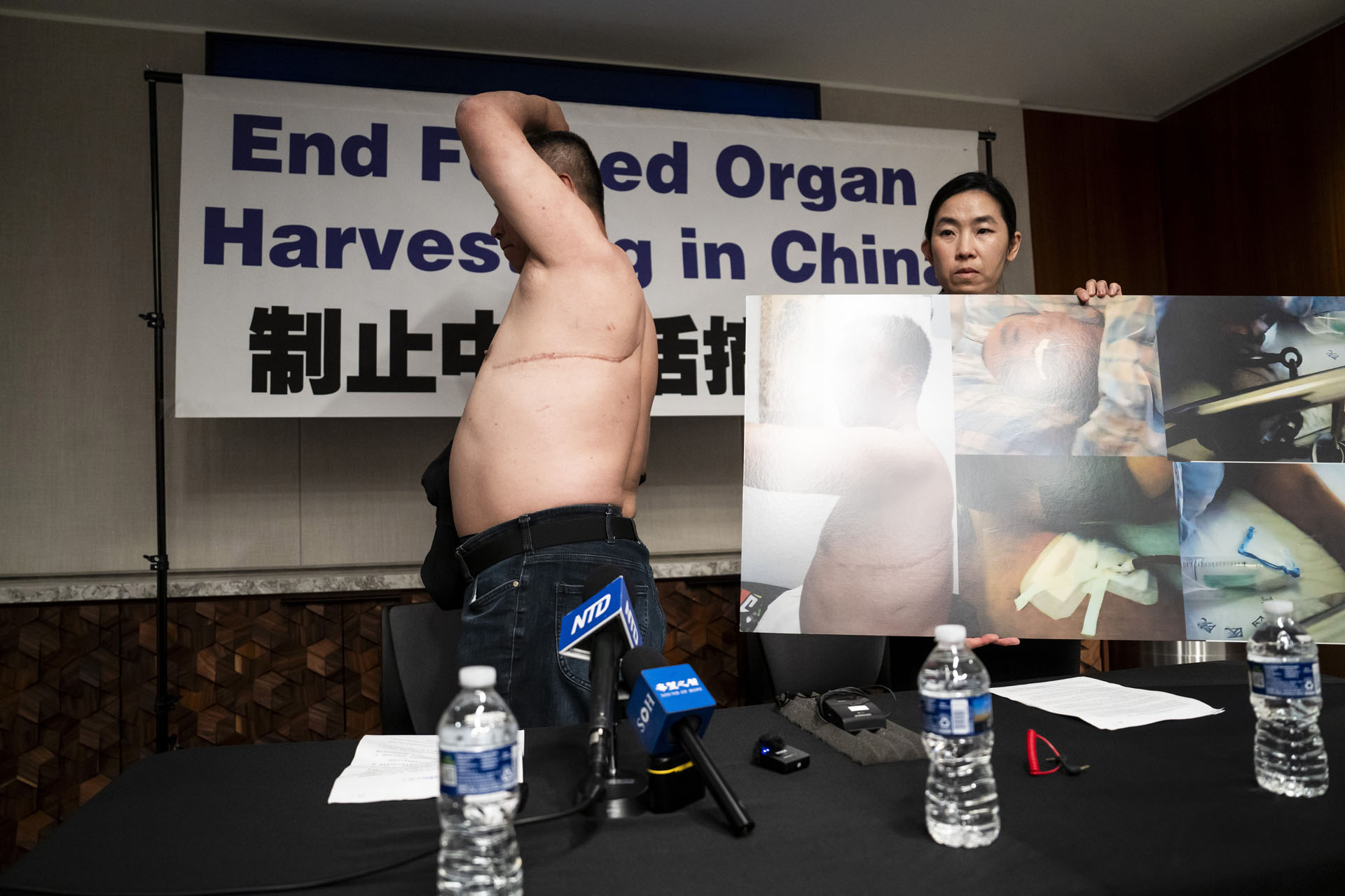 图2:二零二四年七月三日下午,来自中国大陆的法轮功学员程佩明在美国首都华盛顿举办的记者会上,向现场记者展示了上身左侧被缝合的刀口。